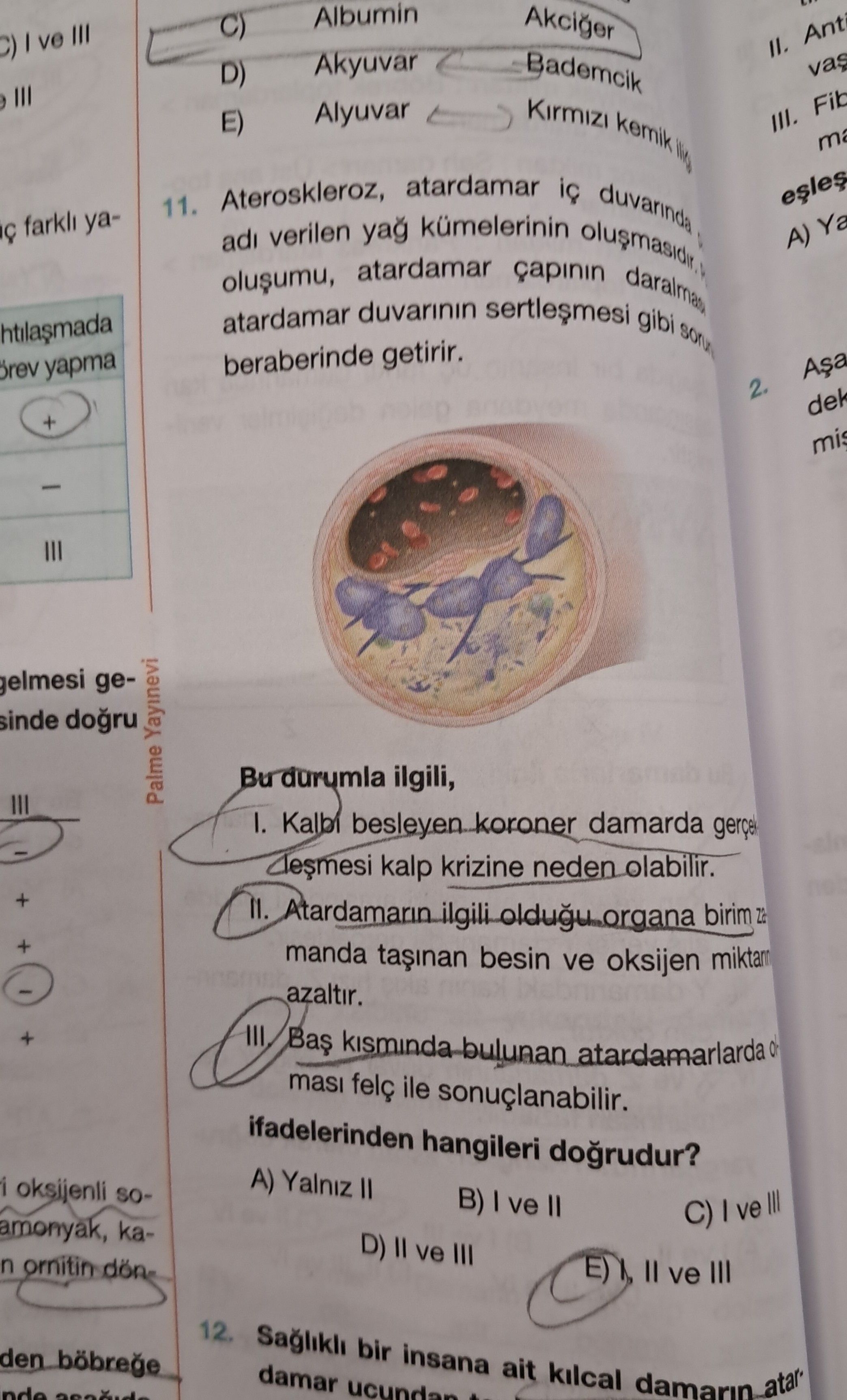 Ateroskleroz, atardamar iç duvarında adı verilen yağ kümelerinin oluşmasıdır. oluşumu, atardamar