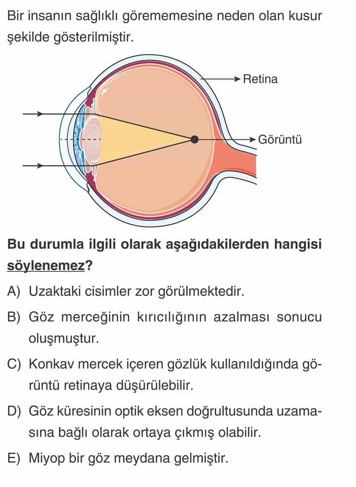 Bir insanın sağlıklı görememesine neden olan kusur şekilde gösterilmiştir. Bu durumla ilgili olarak