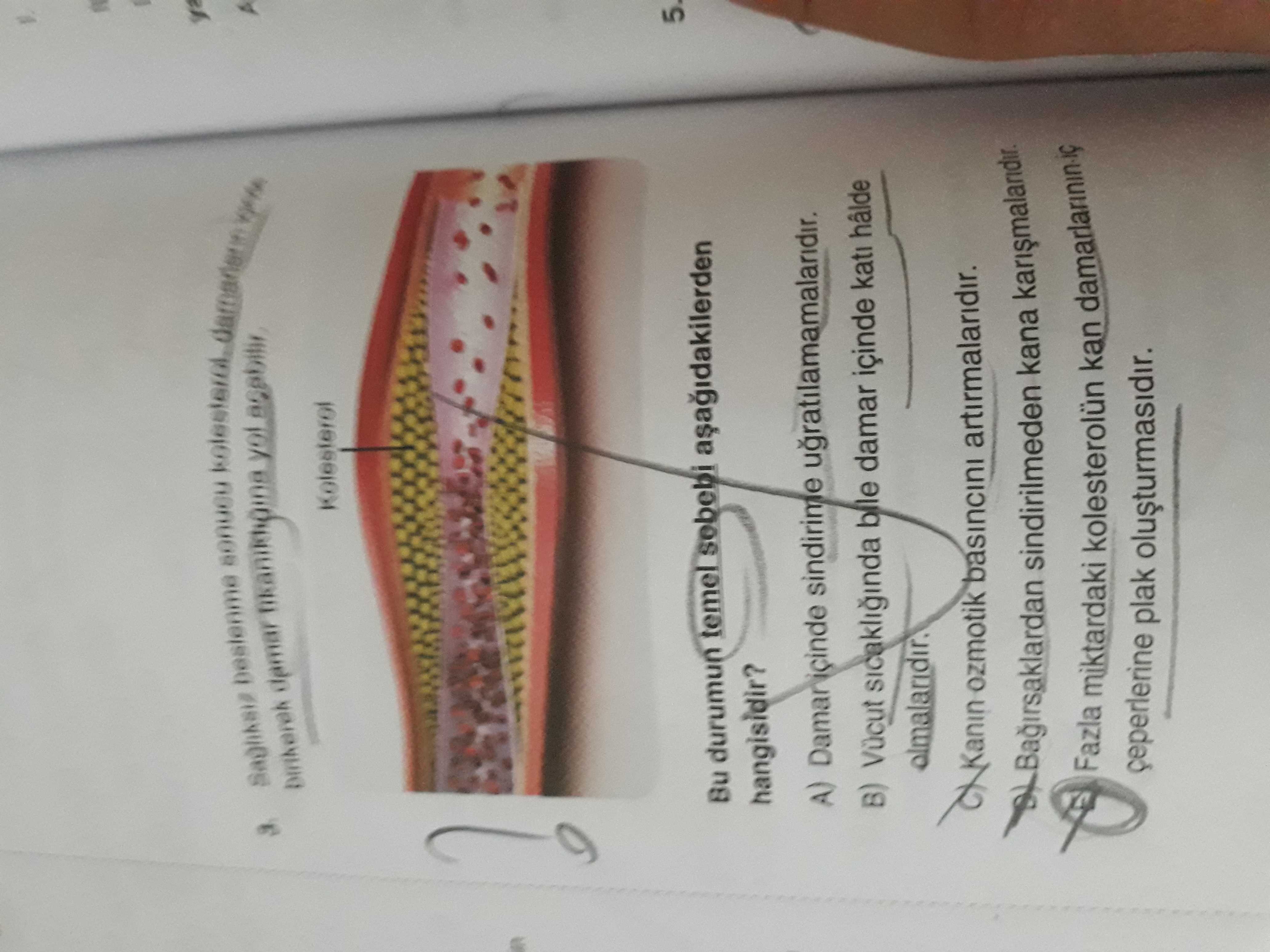 Damar you Kolesterol Bu durumun temel sebebi hangisidir. A) sindirime ugratilamamalaridir. B) Vücut sicakliginda bile damar içinde kati hâlde ozmotik basincini artirmalaridir. sindirilmeden kana Fazla miktardaki kolesterolün kan plak olusturmasidir. ?? Model.Question.title